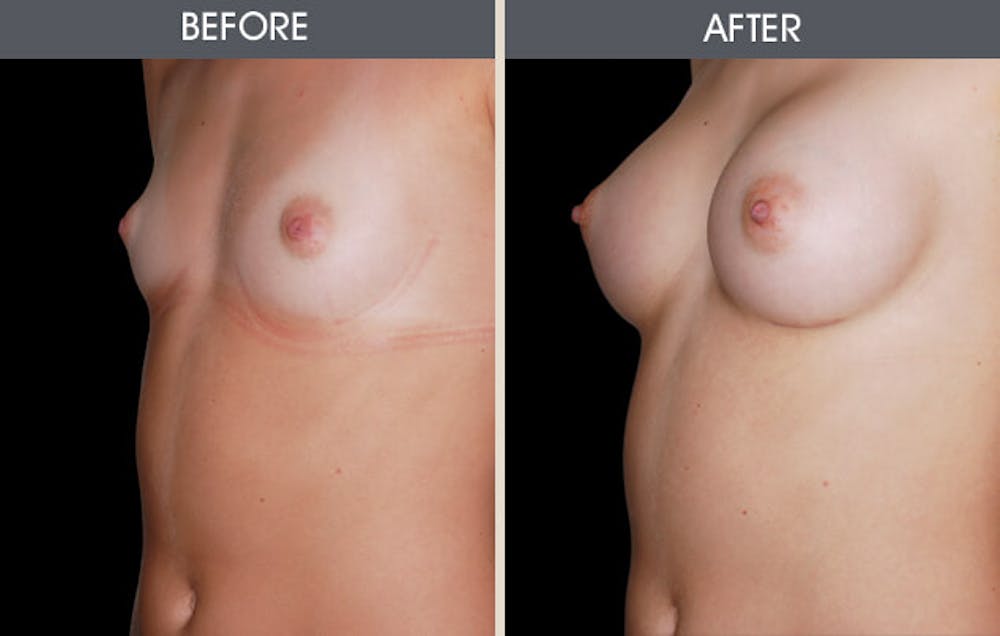 Breast Augmentation Gallery Before & After Gallery - Patient 2207155 - Image 1