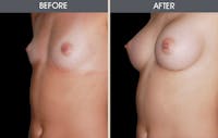 Breast Augmentation Before & After Gallery - Patient 2207155 - Image 1