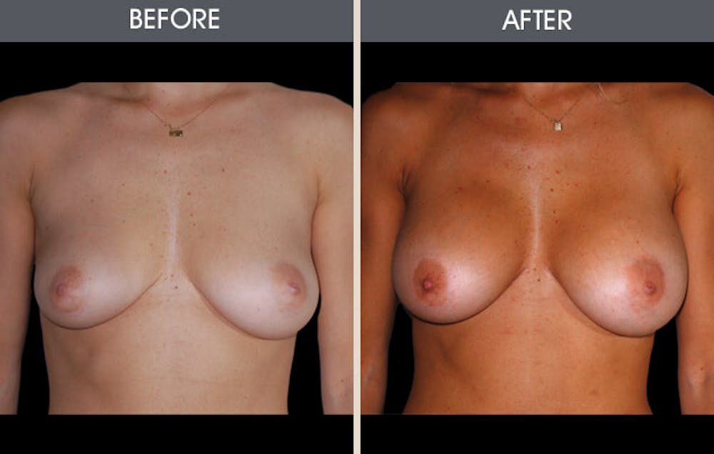 Breast Augmentation Gallery Before & After Gallery - Patient 2207156 - Image 1
