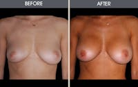 Breast Augmentation Gallery Before & After Gallery - Patient 2207156 - Image 1