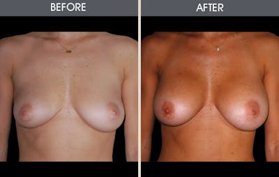 Breast Augmentation Gallery Before & After Gallery - Patient 2207156 - Image 1