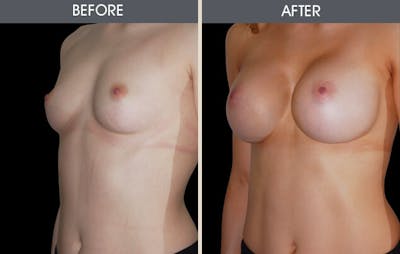 Breast Augmentation Gallery Before & After Gallery - Patient 2207157 - Image 1