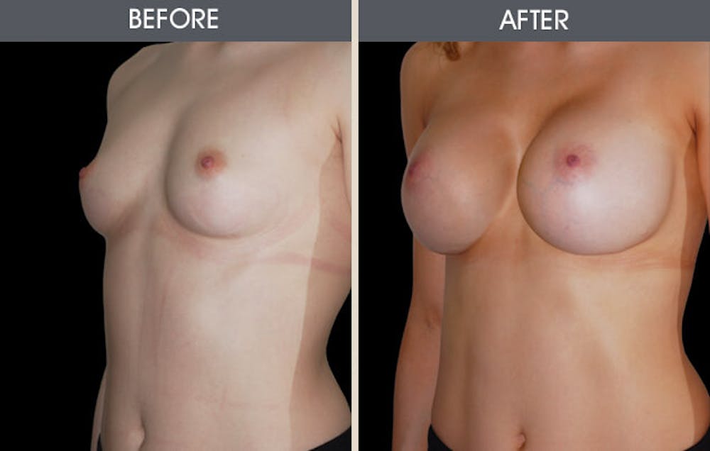 Breast Augmentation Before & After Gallery - Patient 2207157 - Image 1