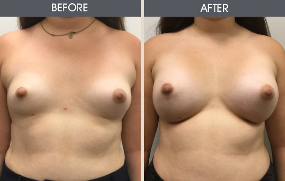 Breast Augmentation Gallery Before & After Gallery - Patient 2207162 - Image 1