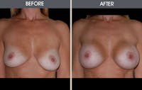 Breast Augmentation Gallery Before & After Gallery - Patient 2207164 - Image 1