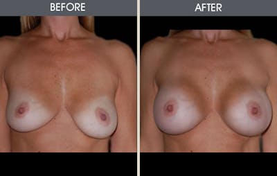 Breast Augmentation Before & After Gallery - Patient 2207164 - Image 1