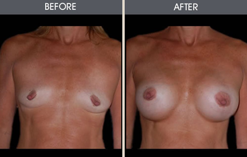 Breast Augmentation Gallery Before & After Gallery - Patient 2207165 - Image 1