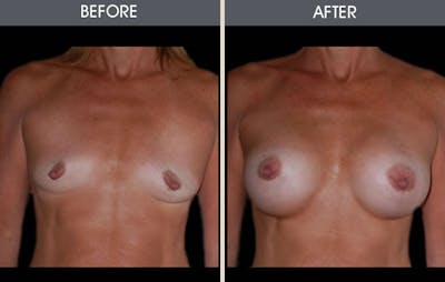 Breast Augmentation Gallery Before & After Gallery - Patient 2207165 - Image 1