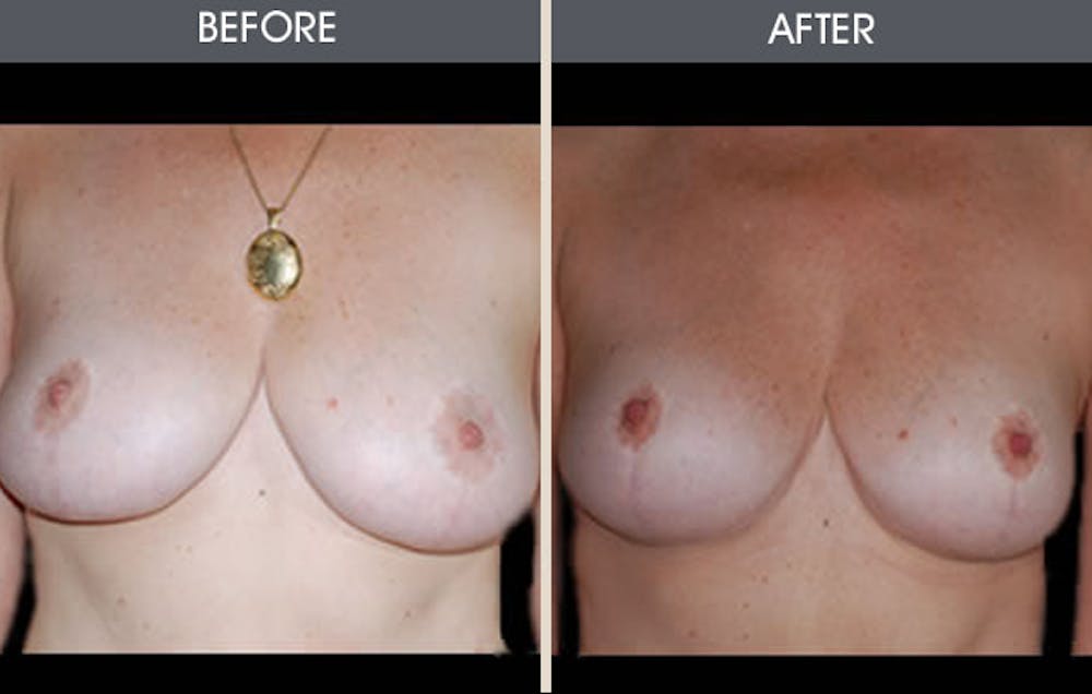 Breast Lift Gallery Before & After Gallery - Patient 2207166 - Image 1