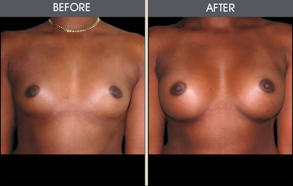Breast Augmentation Before & After Gallery - Patient 2207167 - Image 1