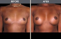 Breast Augmentation Gallery Before & After Gallery - Patient 2207167 - Image 1