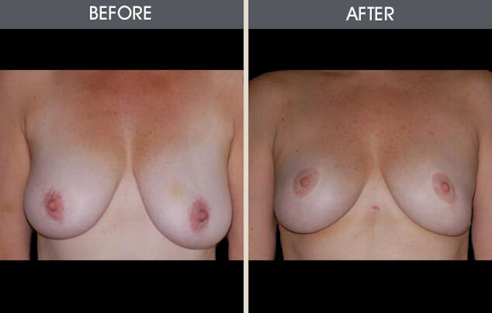 Breast Lift Before & After Gallery - Patient 2207169 - Image 1