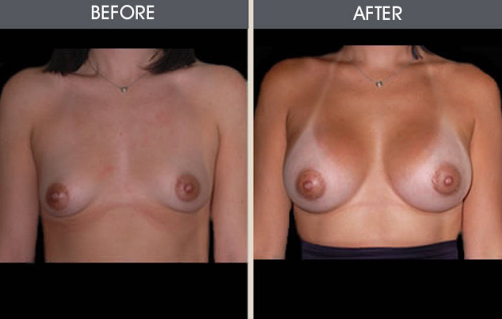 Breast Augmentation Gallery Before & After Gallery - Patient 2207171 - Image 1