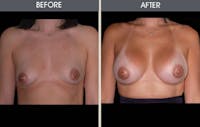 Breast Augmentation Before & After Gallery - Patient 2207171 - Image 1