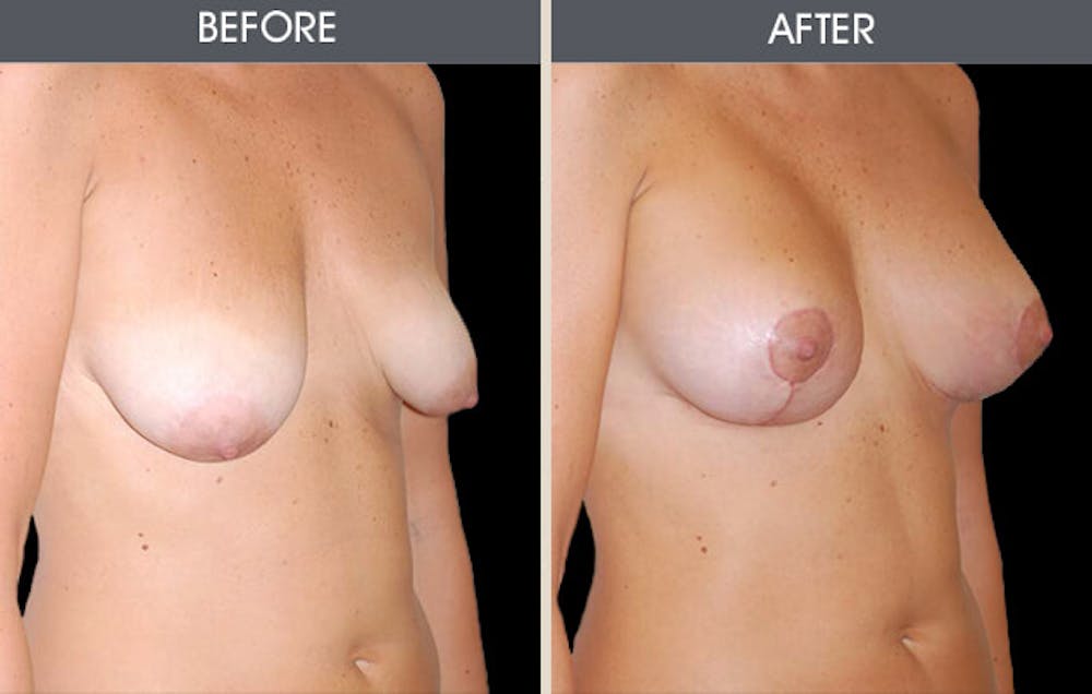 Breast Lift Gallery Before & After Gallery - Patient 2207172 - Image 1