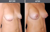Breast Lift Before & After Gallery - Patient 2207172 - Image 1