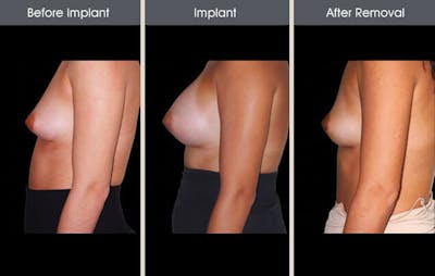 Breast Implant Removal Before & After Gallery - Patient 2207173 - Image 1