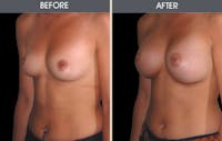Breast Augmentation Before & After Gallery - Patient 2207174 - Image 1