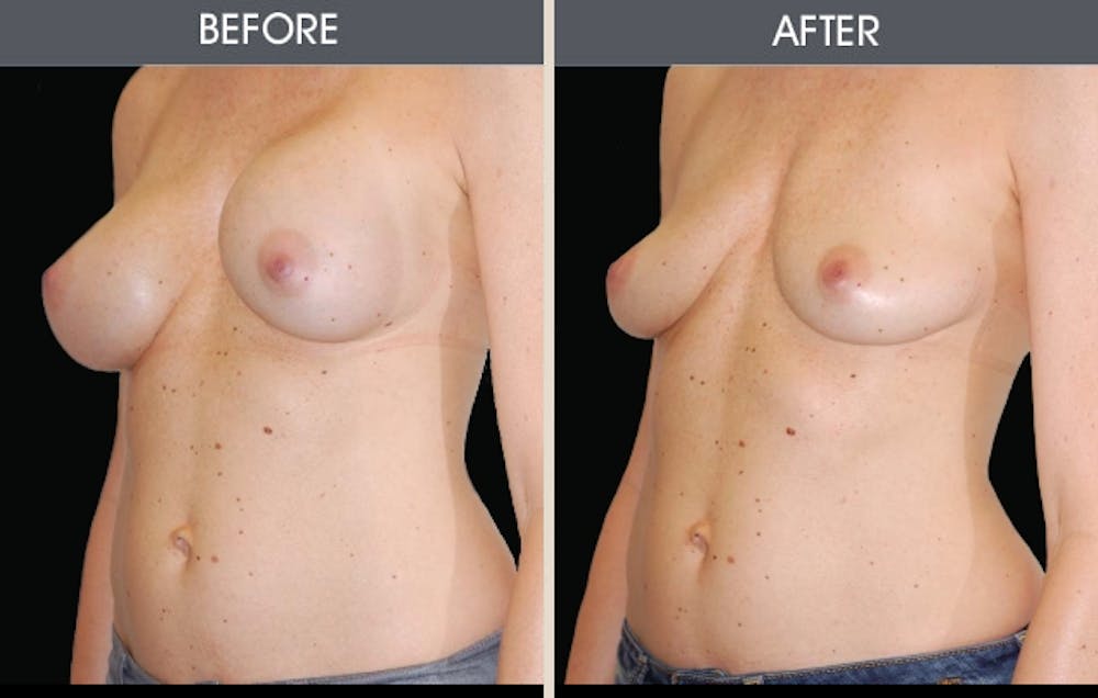 Breast Implant Removal Gallery Before & After Gallery - Patient 2207176 - Image 1