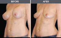 Breast Implant Removal Gallery Before & After Gallery - Patient 2207176 - Image 1