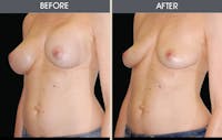 Breast Implant Removal Before & After Gallery - Patient 2207176 - Image 1