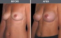 Breast Augmentation Before & After Gallery - Patient 2207177 - Image 1