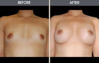 Breast Augmentation Gallery Before & After Gallery - Patient 2207180 - Image 1