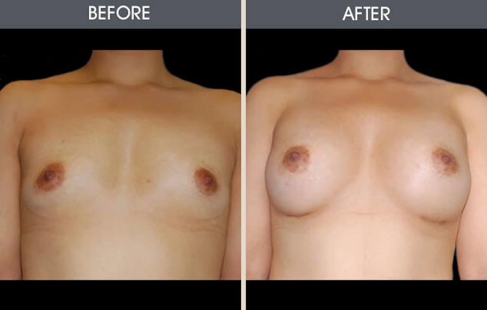 Breast Augmentation Before & After Gallery - Patient 2207180 - Image 1