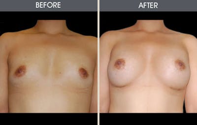 Breast Augmentation Gallery - Patient 2207180 - Image 1