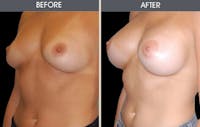 Breast Augmentation Gallery Before & After Gallery - Patient 2207181 - Image 1