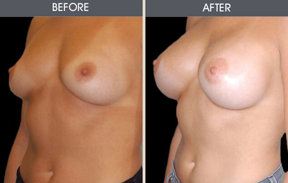 Breast Augmentation Before & After Gallery - Patient 2207181 - Image 1