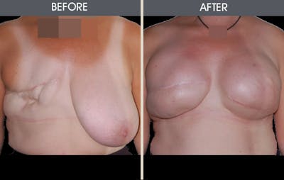 Breast Reconstruction Gallery Before & After Gallery - Patient 2207182 - Image 1