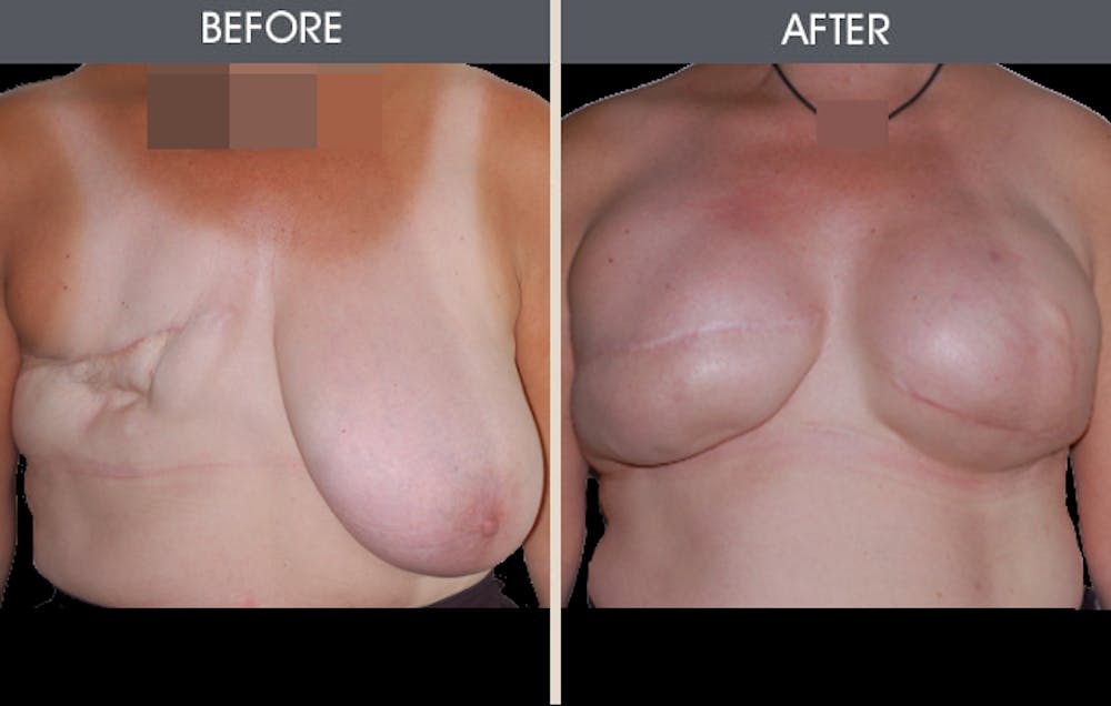Breast Reconstruction Gallery - Patient 2207182 - Image 1