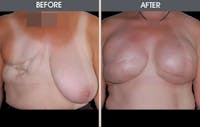 Breast Reconstruction Before & After Gallery - Patient 2207182 - Image 1