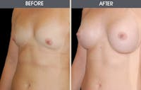Breast Augmentation Before & After Gallery - Patient 2207184 - Image 1