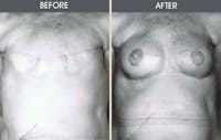 Breast Reconstruction Before & After Gallery - Patient 2207186 - Image 1