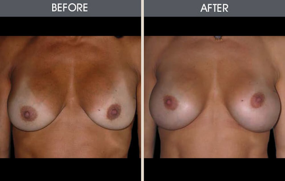 Breast Augmentation Gallery Before & After Gallery - Patient 2207185 - Image 1