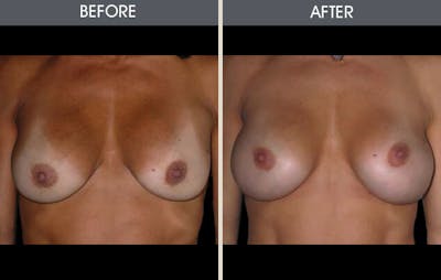 Breast Augmentation Gallery Before & After Gallery - Patient 2207185 - Image 1