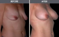 Breast Augmentation Gallery Before & After Gallery - Patient 2207188 - Image 1
