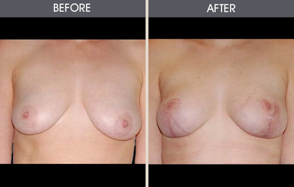 Breast Reconstruction Gallery Before & After Gallery - Patient 2207187 - Image 1