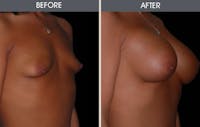Breast Augmentation Before & After Gallery - Patient 2207192 - Image 1