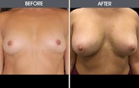 Breast Augmentation Before & After Gallery - Patient 2207194 - Image 1