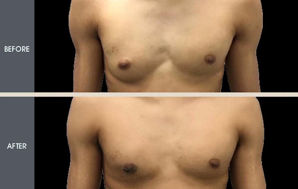 Male Breast Reduction (Gynecomastia)  Before & After Gallery - Patient 2207196 - Image 1