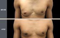Male Breast Reduction Before & After Gallery - Patient 2207196 - Image 1