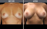 Breast Augmentation Before & After Gallery - Patient 2207207 - Image 1