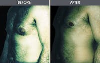Male Breast Reduction (Gynecomastia) Gallery Before & After Gallery - Patient 2207208 - Image 1