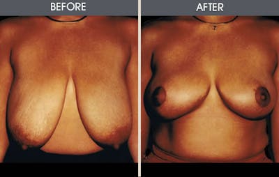 Breast Reduction Before & After Gallery - Patient 2207210 - Image 1