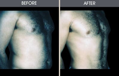 Male Breast Reduction (Gynecomastia) Gallery Before & After Gallery - Patient 2207211 - Image 1
