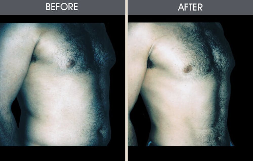 Male Breast Reduction (Gynecomastia)  Before & After Gallery - Patient 2207211 - Image 1