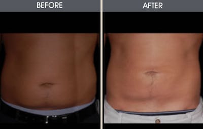 Dr. Antell's Liposuction before & after photo #5